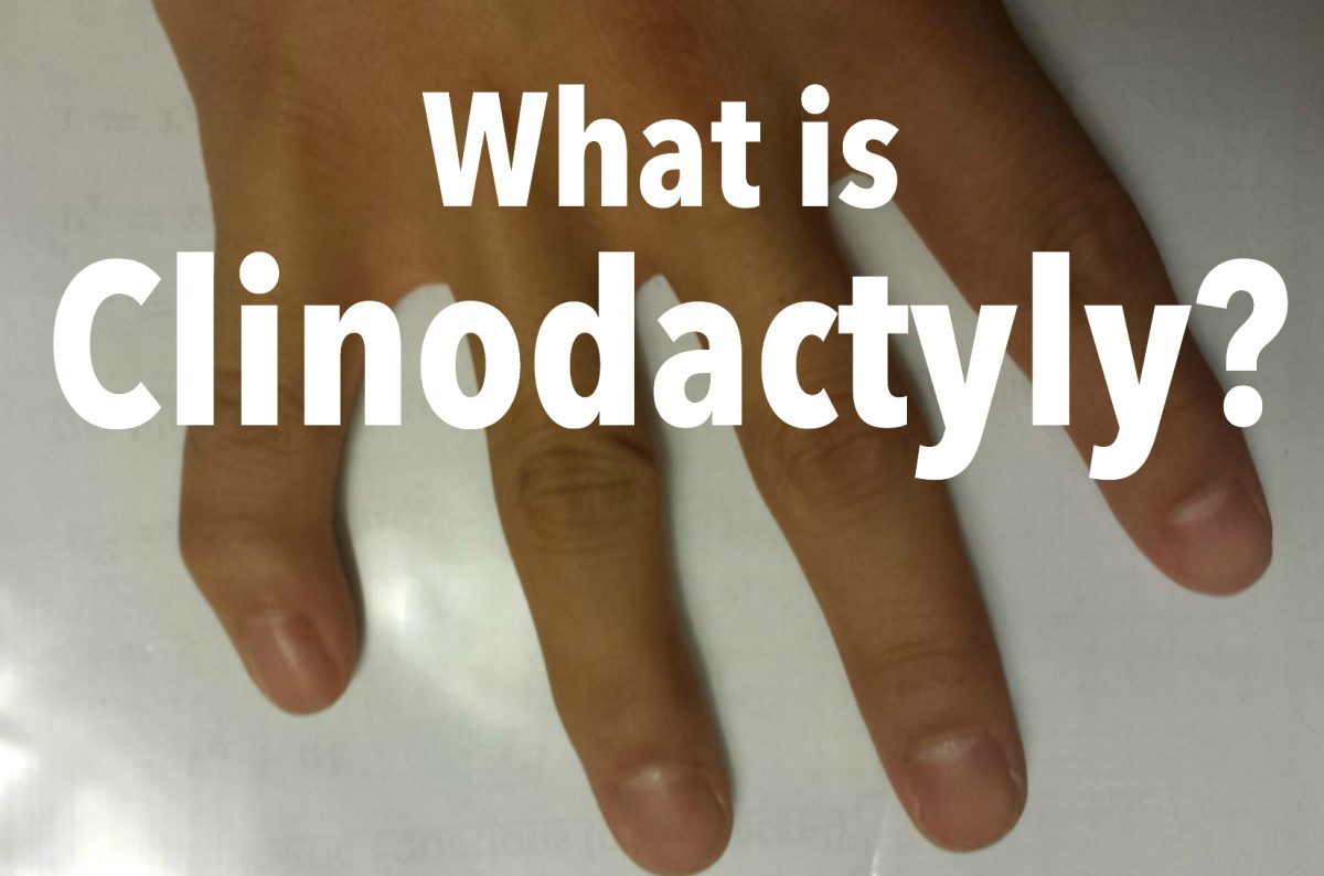 Clinodactyly: A Genetic Abnormality