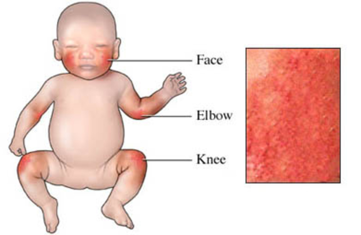 Babies are the most prone to eczema. This picture shows the places it normally is.
