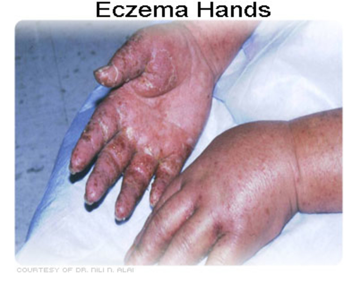 Help for Healing Eczema