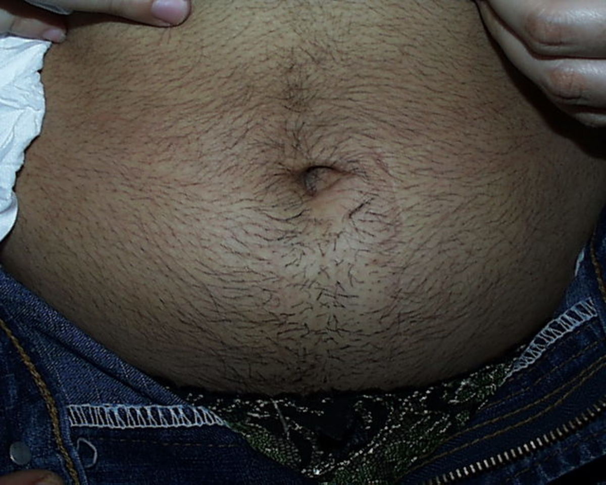 Male-type distribution of body hair may characterise polycystic ovarian syndrome