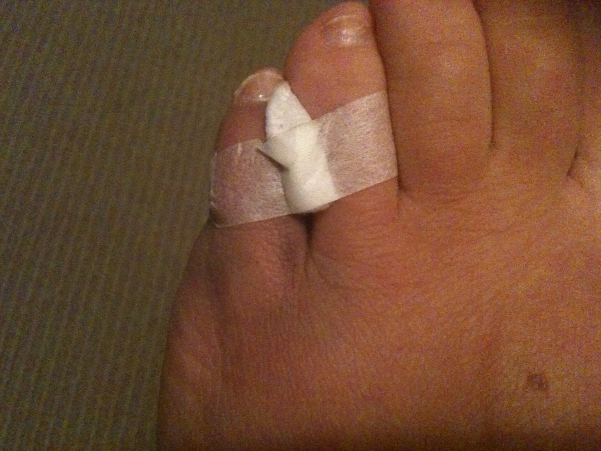 tips-for-treating-a-broken-little-toe