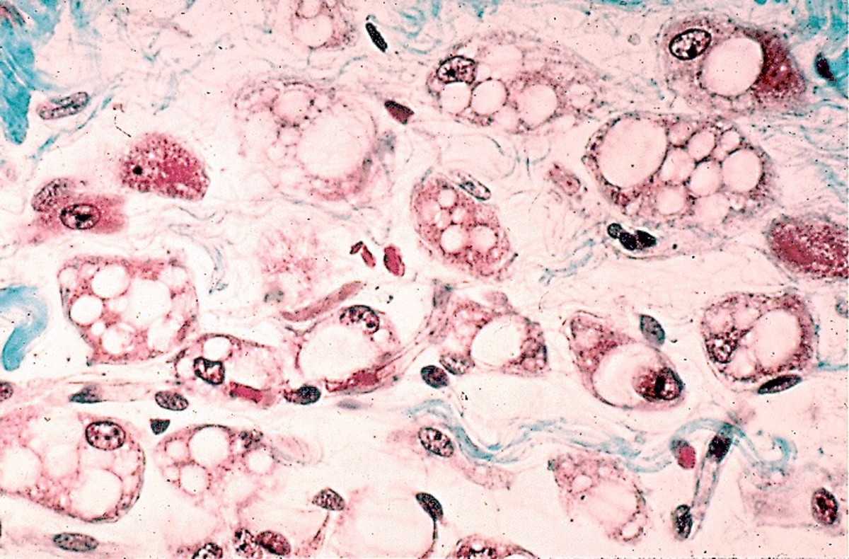Stained brown adipose tissue showing multiple fat droplets in the cells.