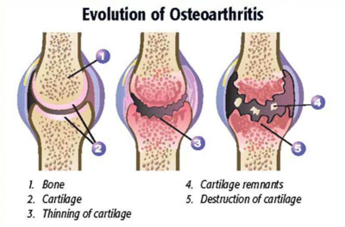 Arthritis is joint inflammation 