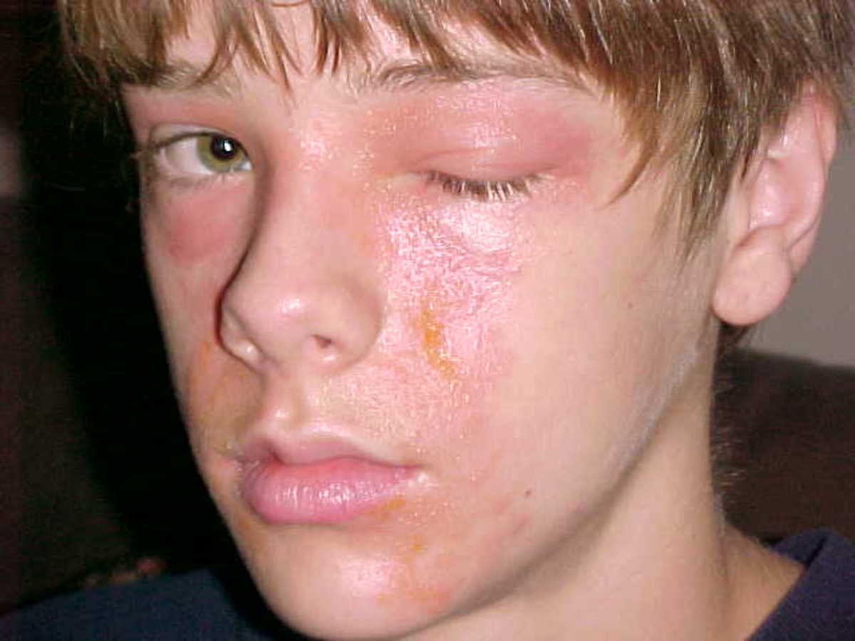 Poison Ivy on the face. His eye is infected and medical attention is needed.