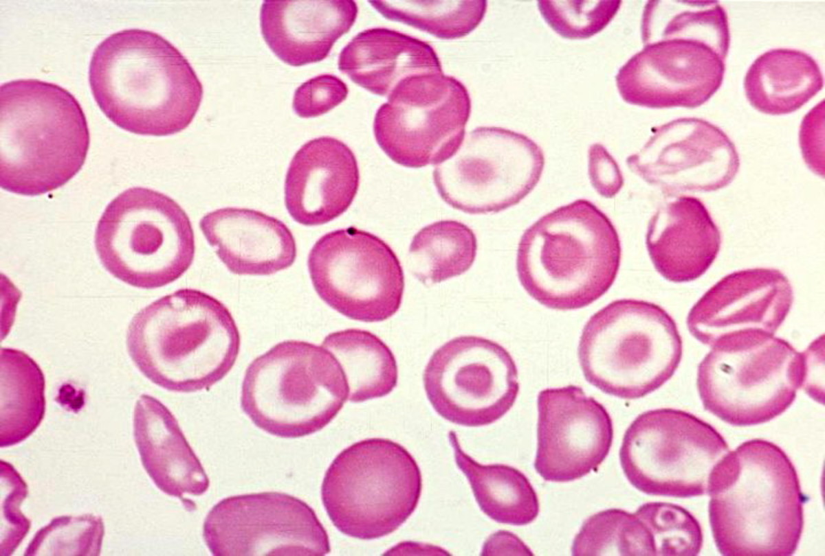 Image of blood cells from a patient with Thalassemia