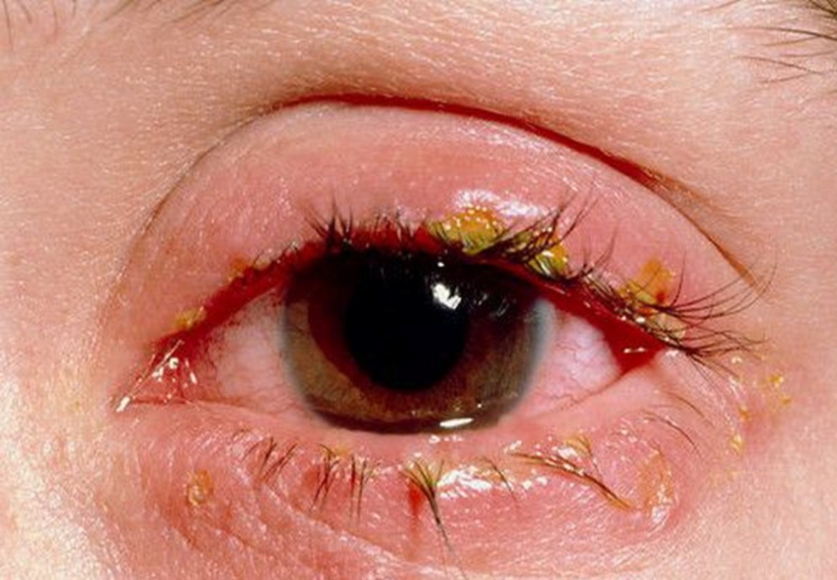 blepharitis-an-eye-sore-for-sure