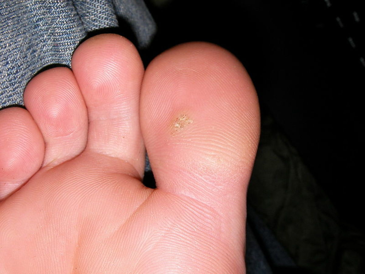 Warts on toes.