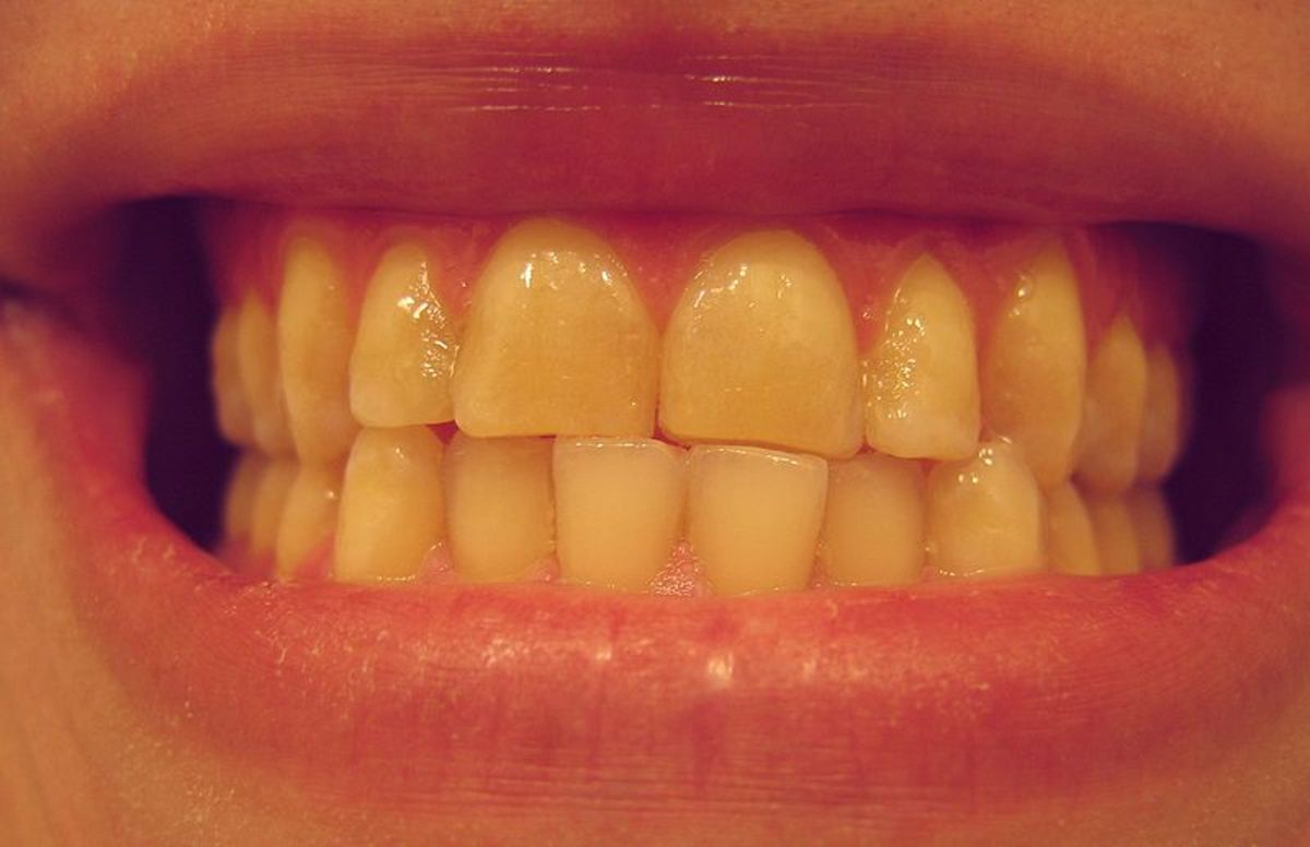 5 Ways to Get Rid of Yellow Teeth