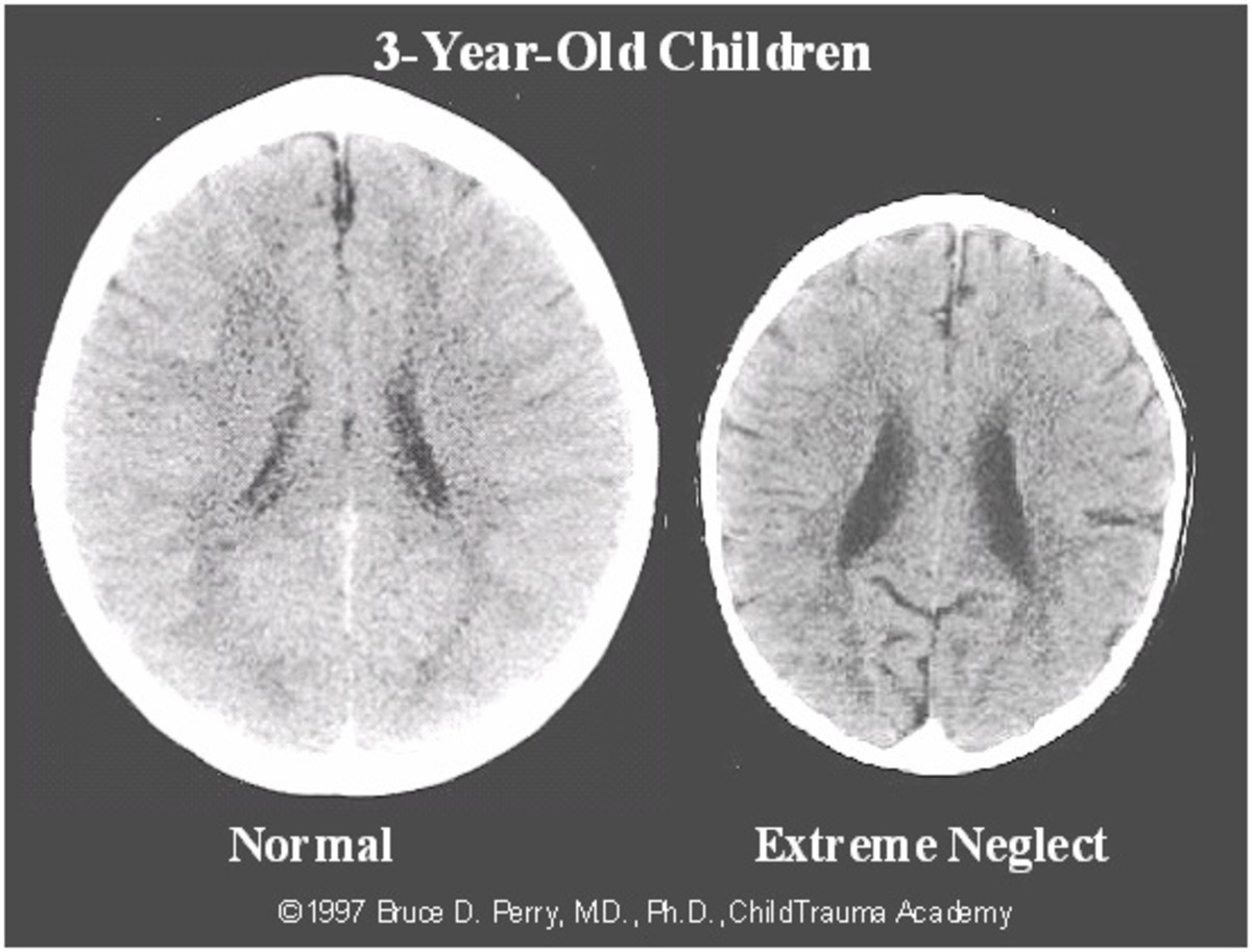Do Neglected Children Suffer More Brain Damage than Abuse Victims?  