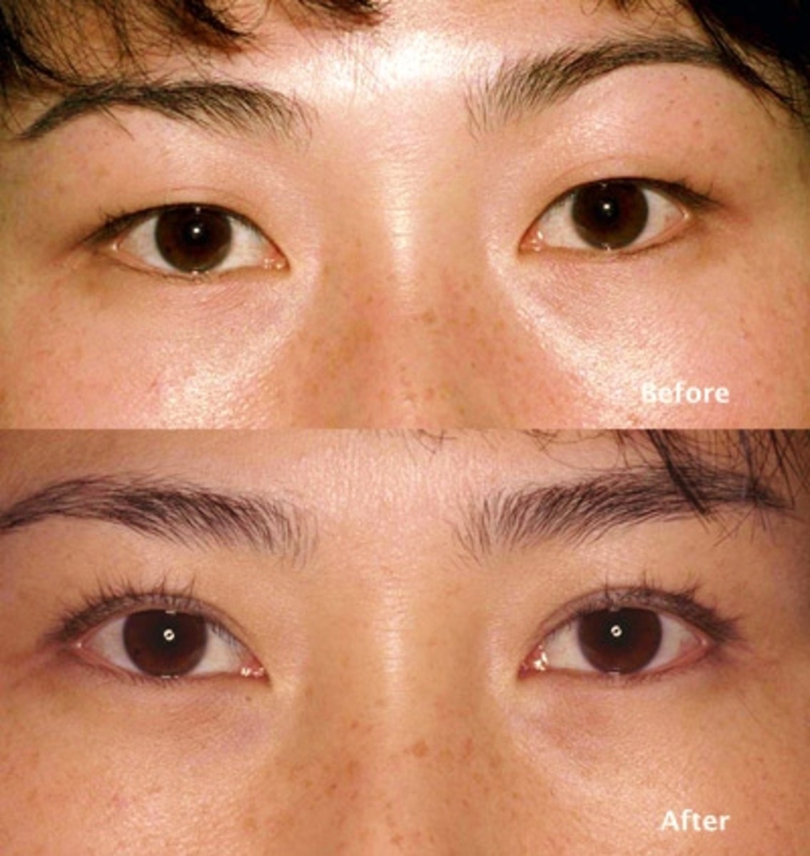 asian-eyelid-surgery-before-and-after-and-cost-of-procedure