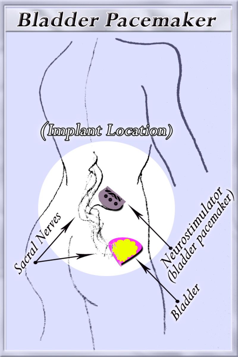 Location of Bladder Pacemaker implant