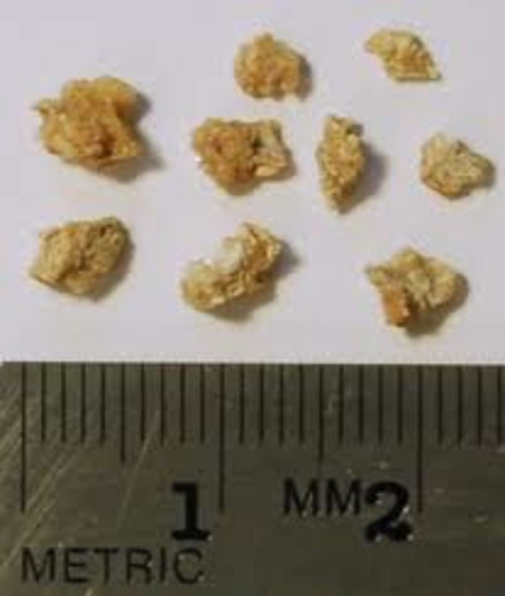 Kidney stones can range in various sizes and shapes and also colors.