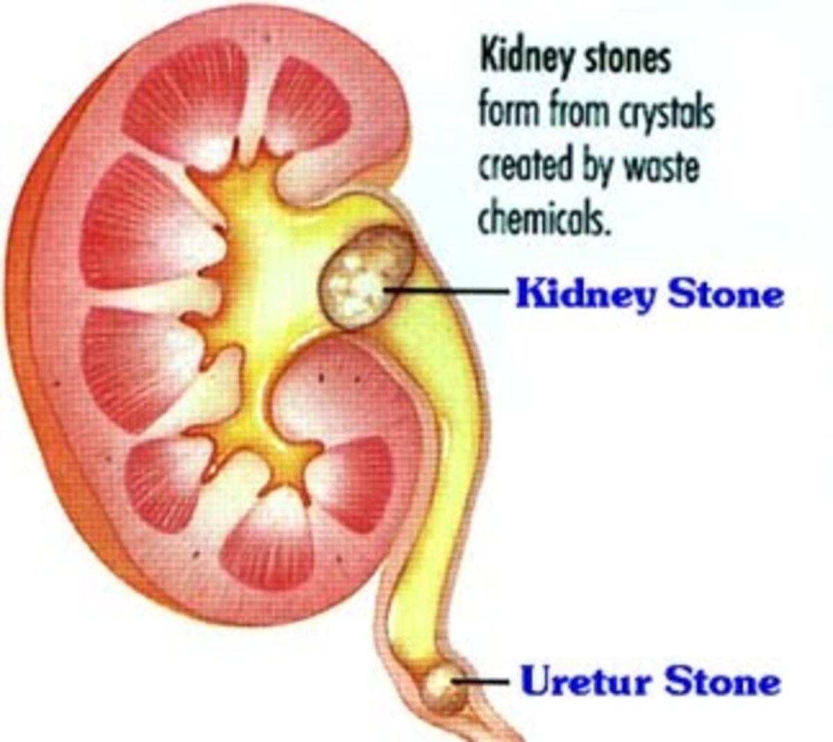 the-pain-of-kidney-stones