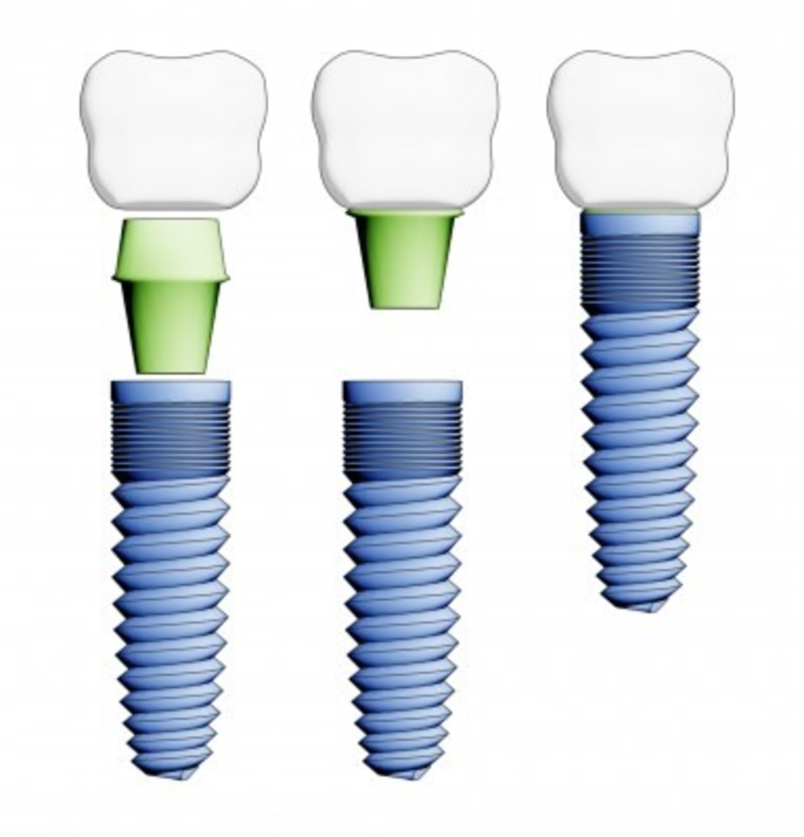 The three parts comprising a tooth implant. The titanium screw below the gumline, the abutment (shown in green) and the tooth crown.