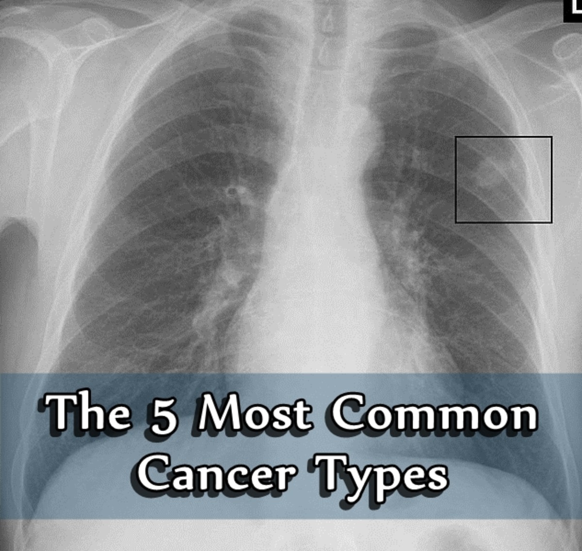 The 5 Most Common Cancer Types