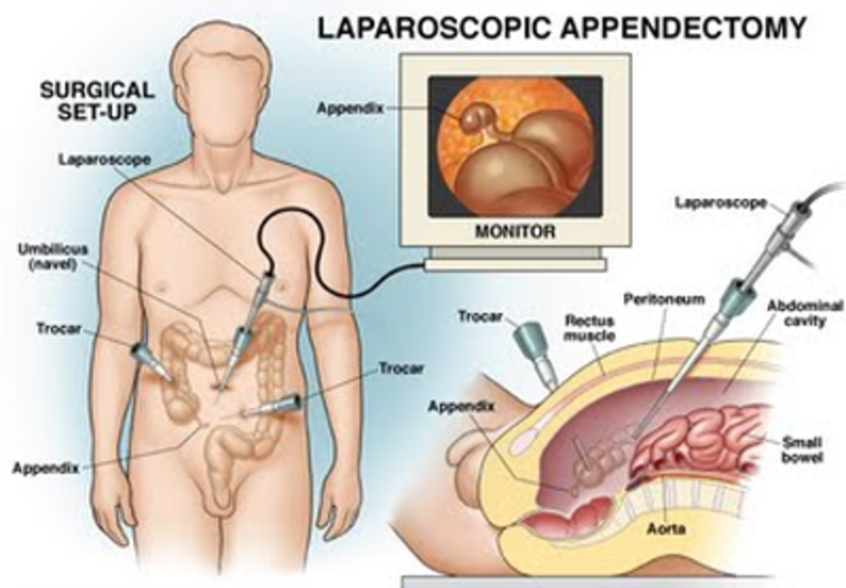 Illustration of laparoscopic appendectomy