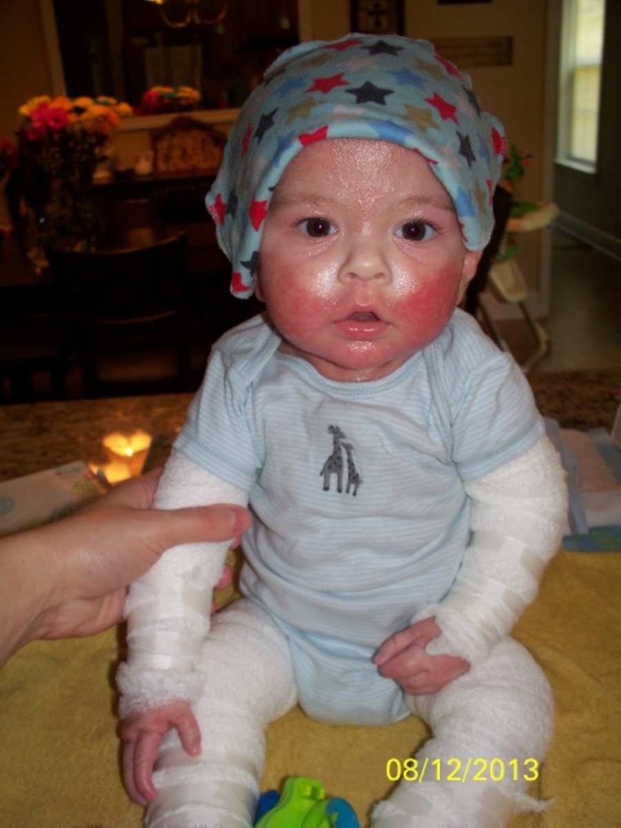 How do You Know if You Have Eczema or Steroid Rebound? HubPages