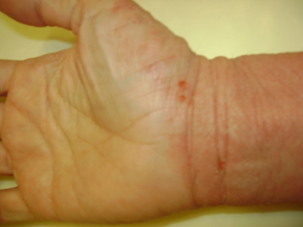 How do You Know if You Have Eczema or Steroid Rebound?