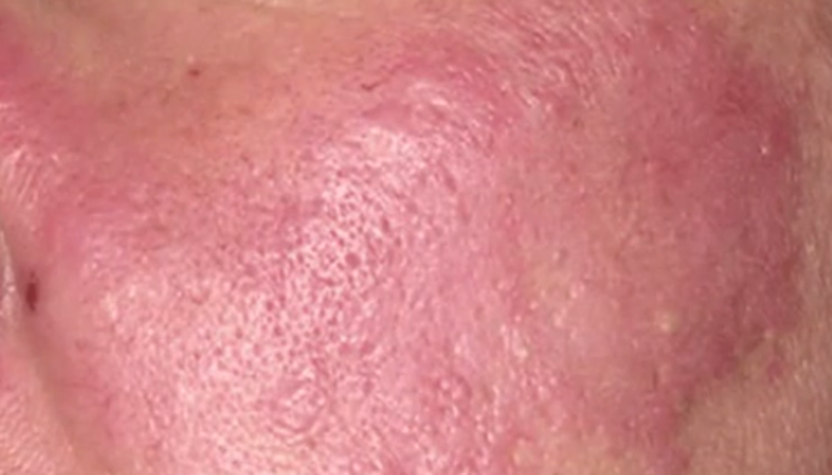 lupus-rash-pictures-symptoms-causes-treatment