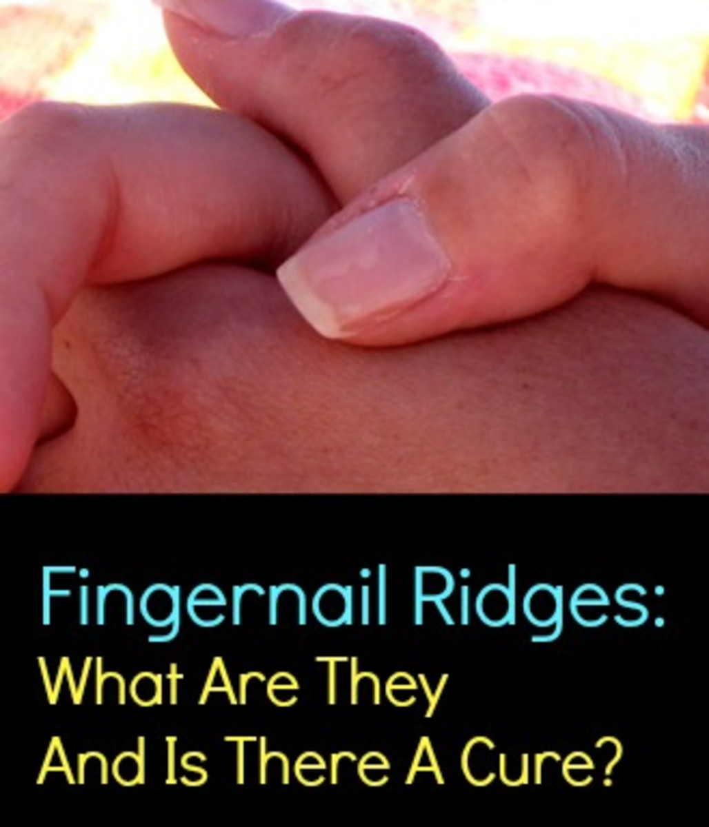 Fingernail Ridges: What Are The Symptoms And Is There A Cure?