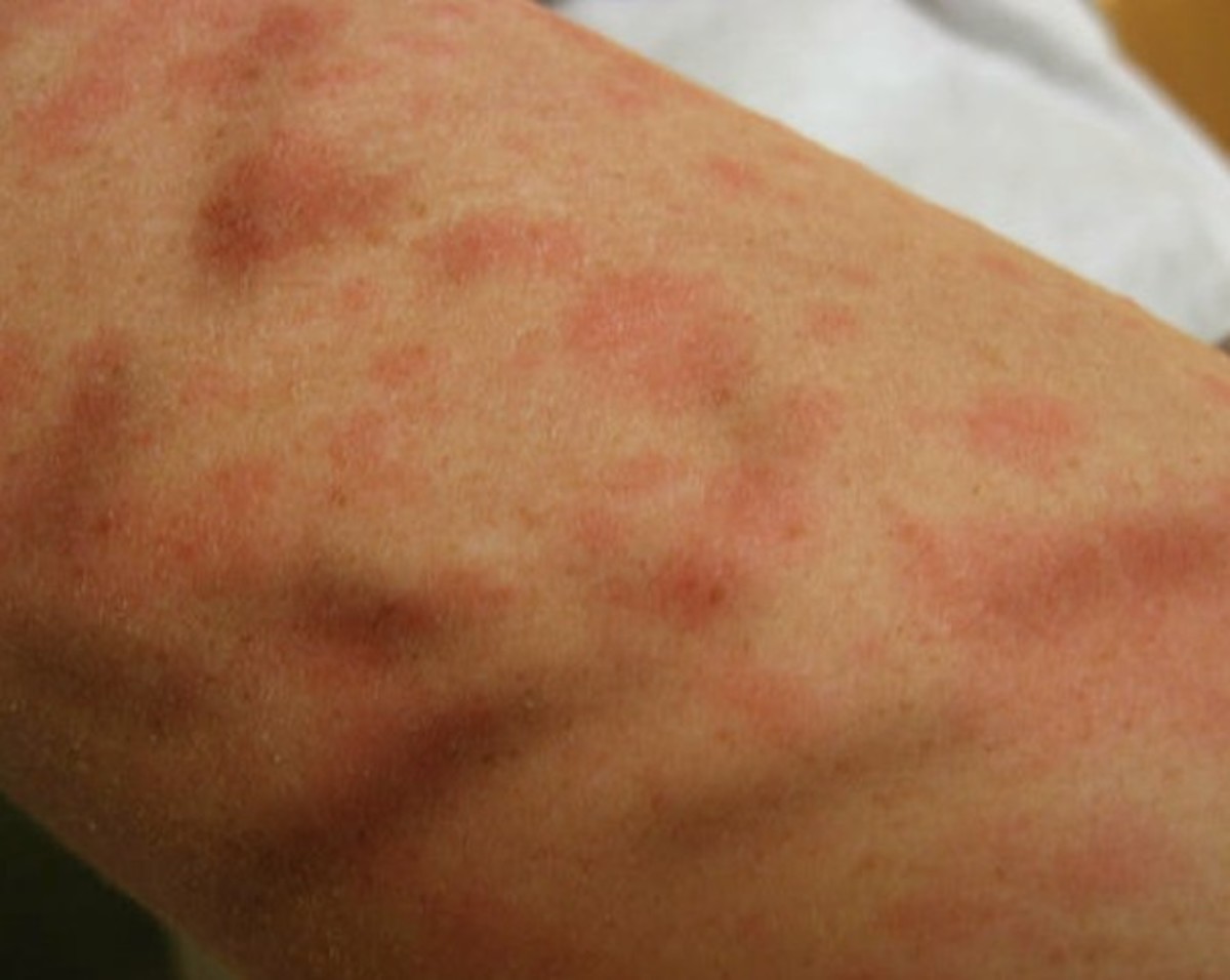 Itchy Red Skin Rash Causes At Curtis Lindsay Blog