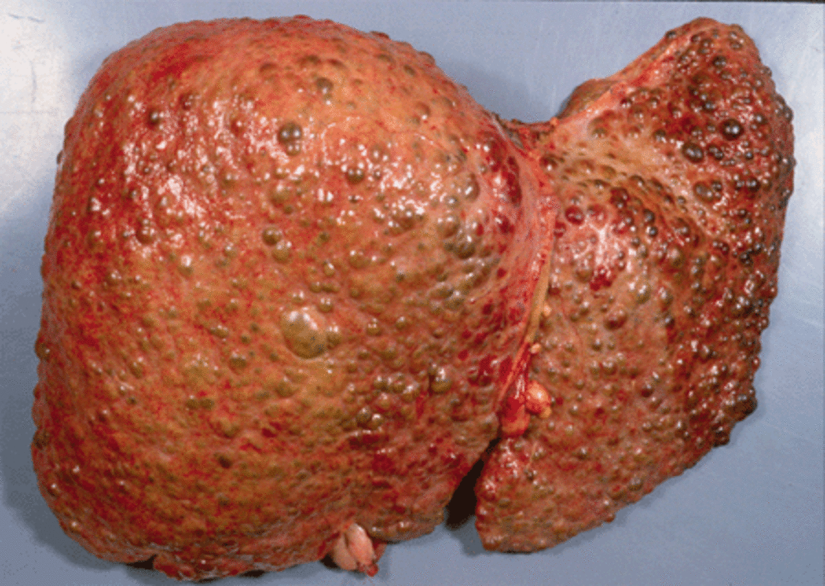 A Cirrhotic liver. 