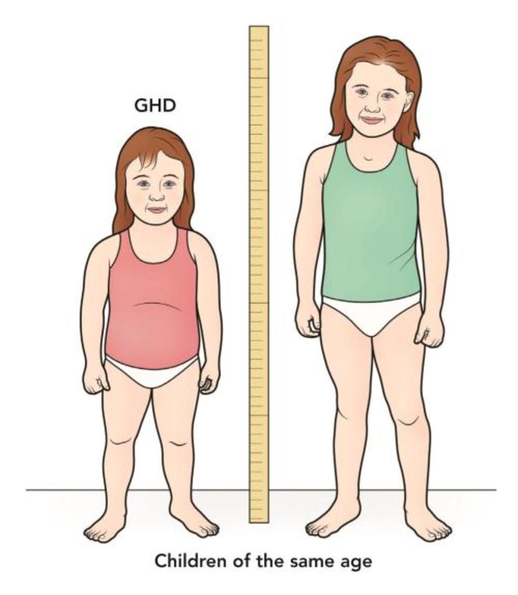 Most children with growth hormone deficiency grow less than 2 inches per year, but in this case the child on the left is much shorter than a child of the same age