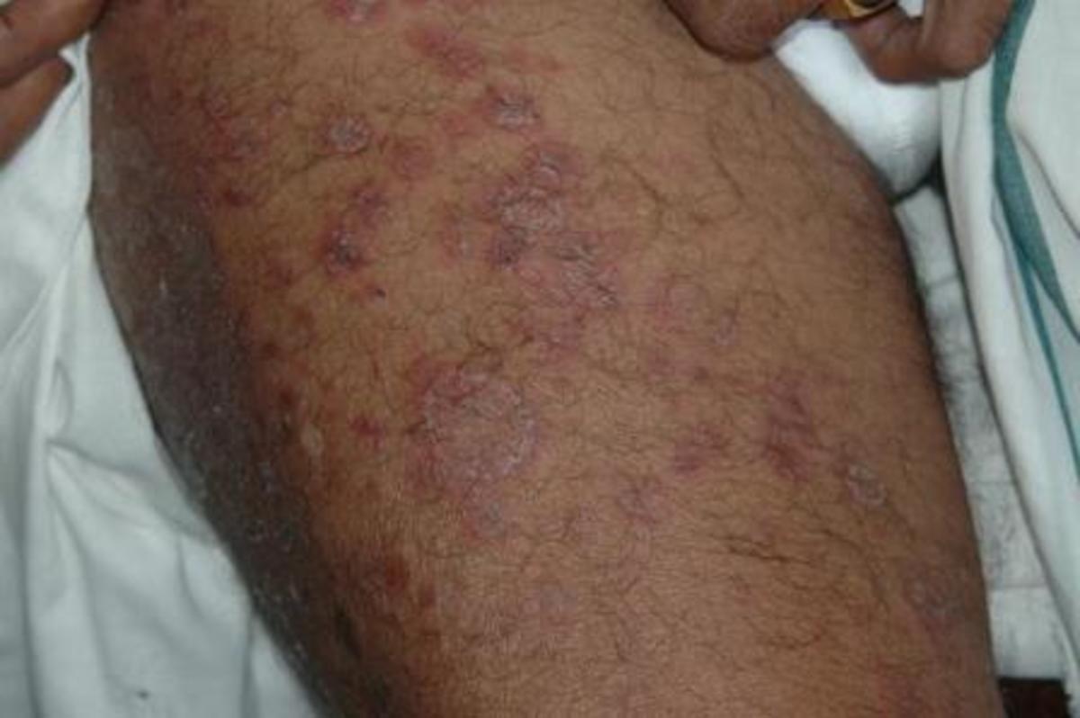 Chikungunya rash