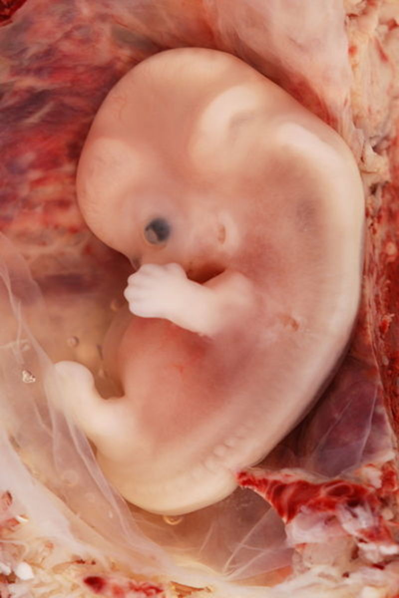 File: 9-Week Human Embryo from Ectopic Pregnancy.jpg  Author: Ed Uthman, Houston, TX, USA  CC-BY-SA 2.0