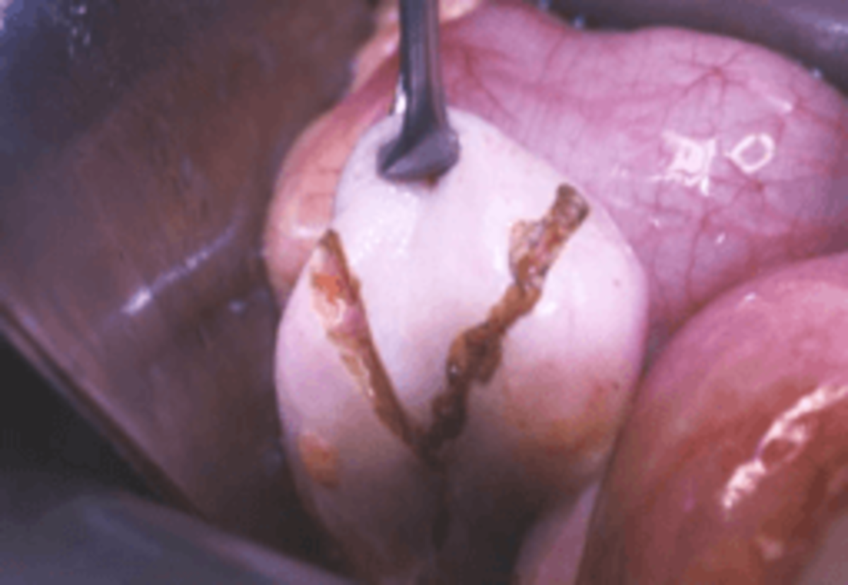 Ovarian Wedge Resection