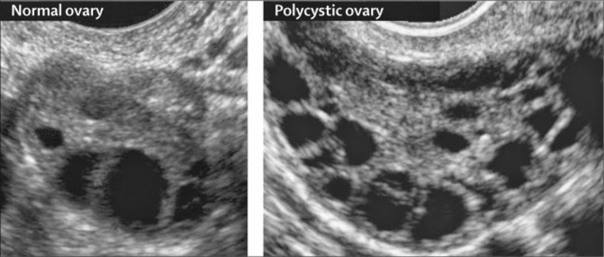 Ultrasound Image of Normal and PCOS ovaries
