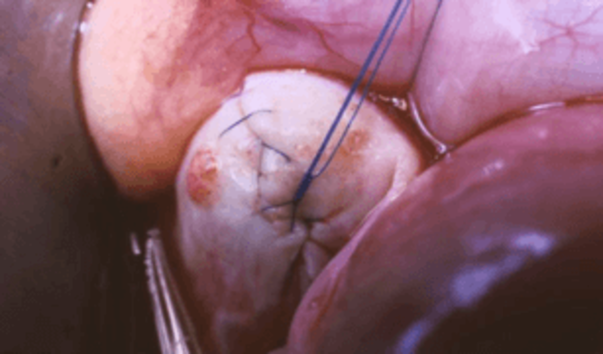 Laparoscopic Ovarian Wedge Resection