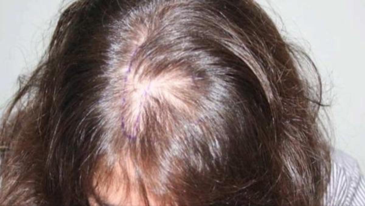Hair Loss in PCOS