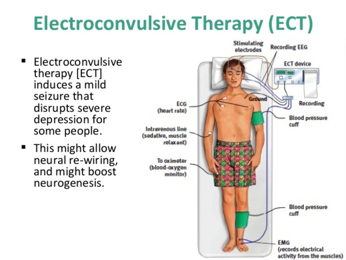 electroconvulsive-therapy-or-shock-therapy