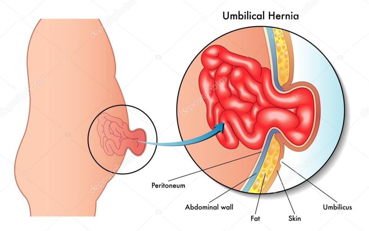 Umbilical Hernia and How to Repair it