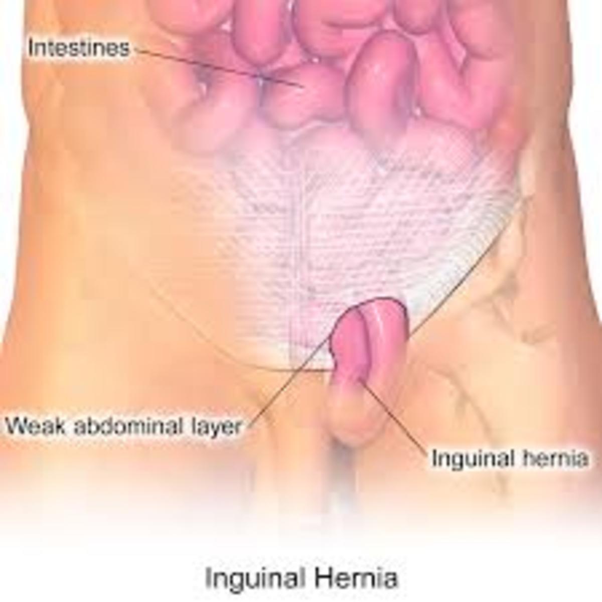 The Inguinal Hernia Location