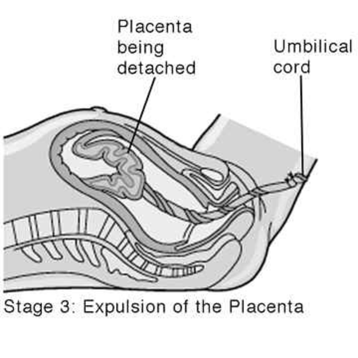 Stage 3 is the expulsion of the placenta.