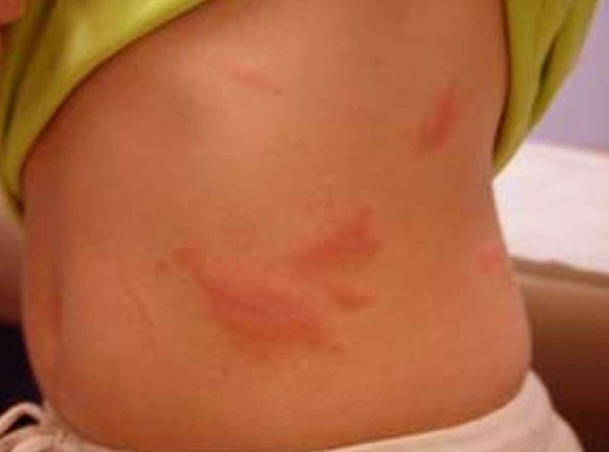 Rash On Stomach Pictures Treatment Symptoms Causes HubPages