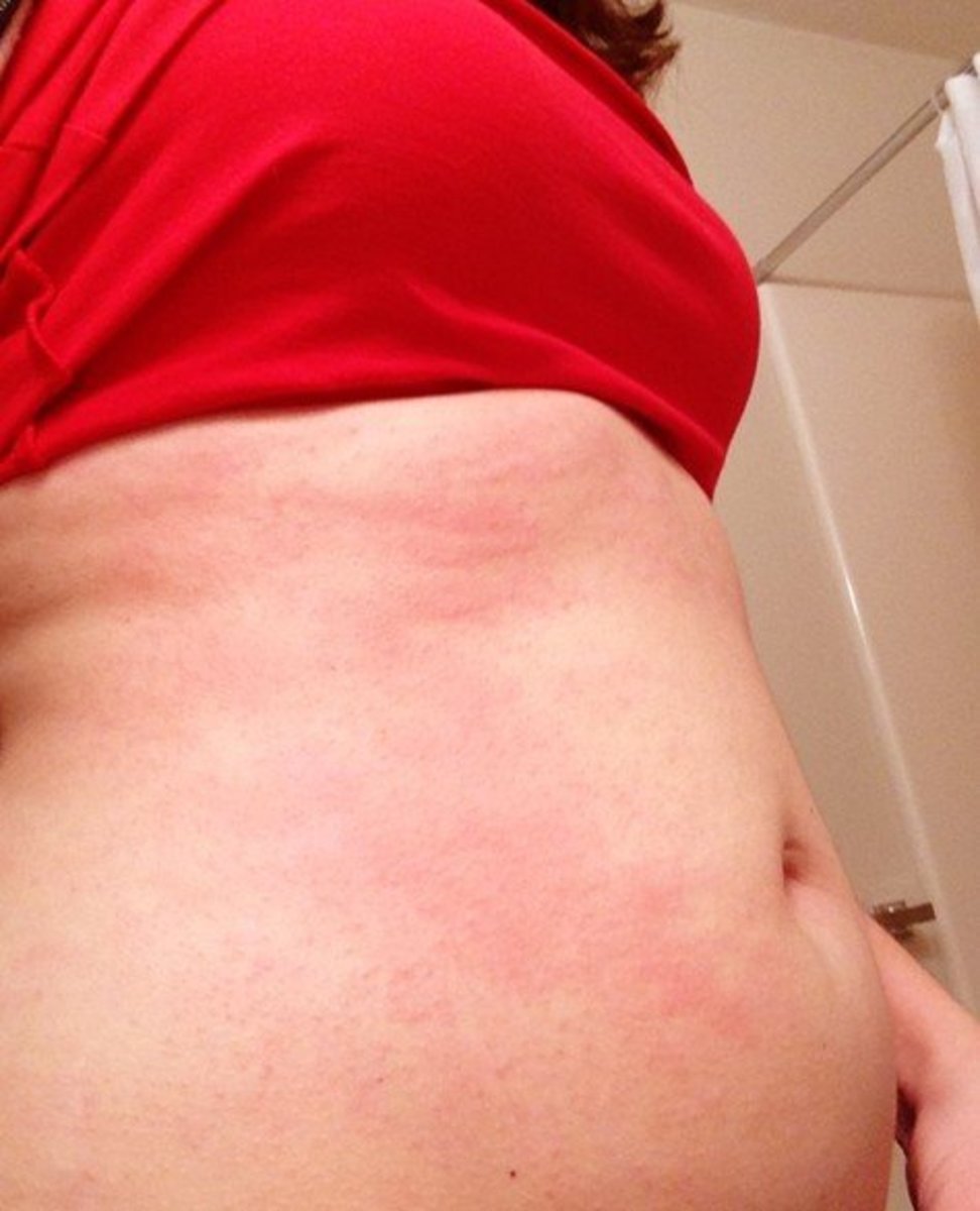 Rash on Stomach - Pictures, Treatment, Symptoms, Causes