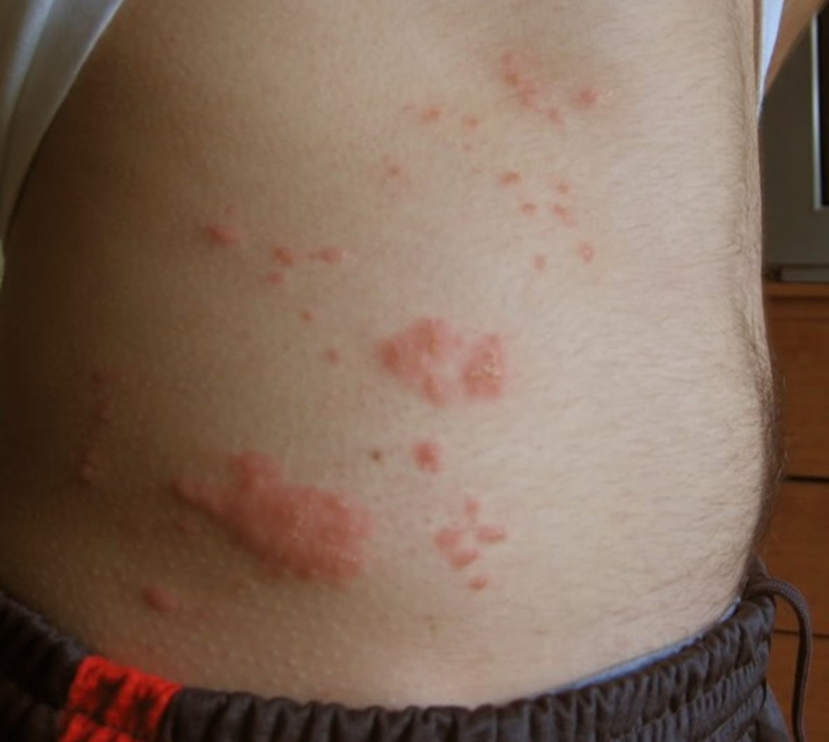 rash-on-stomach-pictures-treatment-symptoms-causes