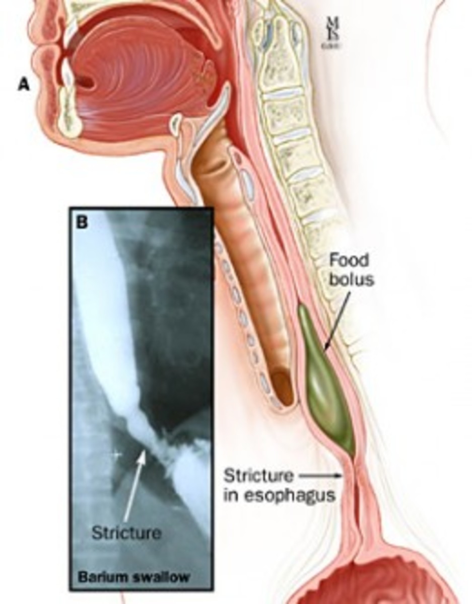 oesophageal-stricture-health-implication-the-story-of-chief-mr-olivier-chukwuemeka-from-enugu-nigeria