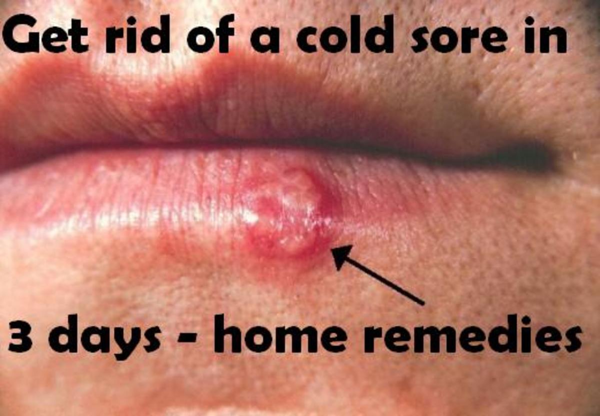 Home Remedies and Over-the-Counter Products to Get Rid of a Cold Sore Quickly