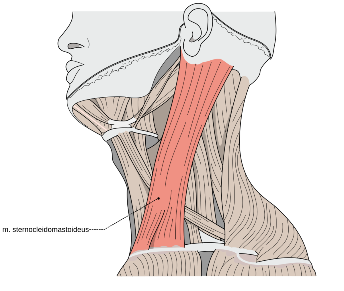 The Sternocleidomastoid Muscle A Culprit Of Widespread Muscle Pain The Sternocleidomastoid Muscle A Culprit Of Widespread Muscle Pain