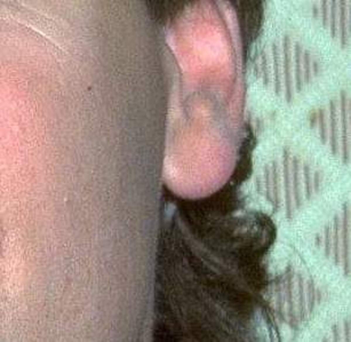 Unattached earlobe of Roger Clinton