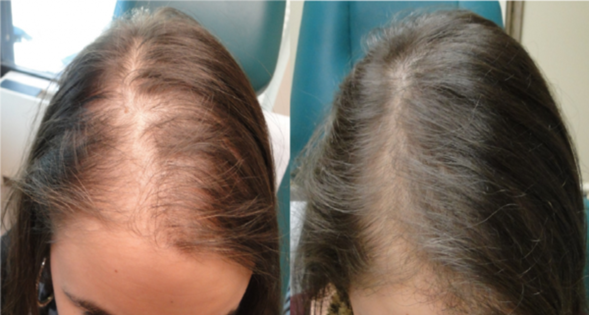 olive-oil-to-prevent-hairloss-or-imrove-hair-growth