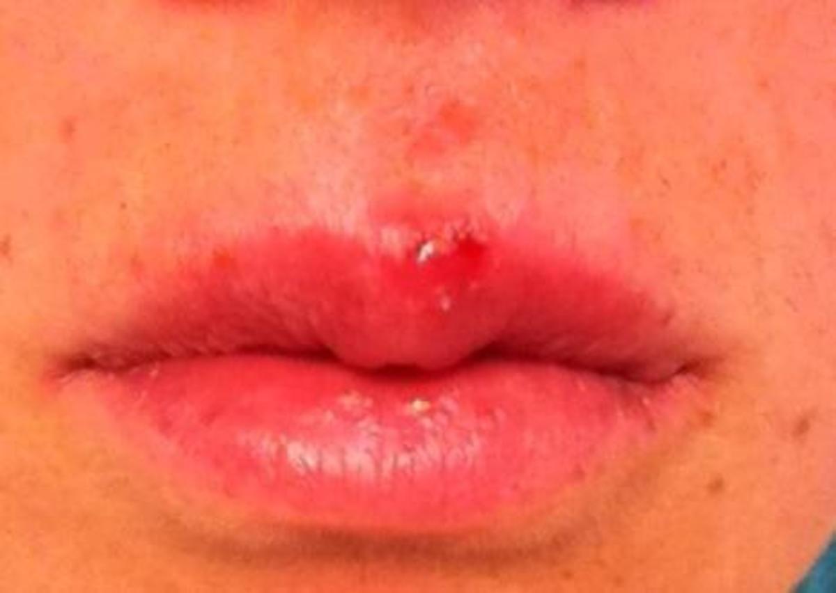 4th day of cold sore, almost gone