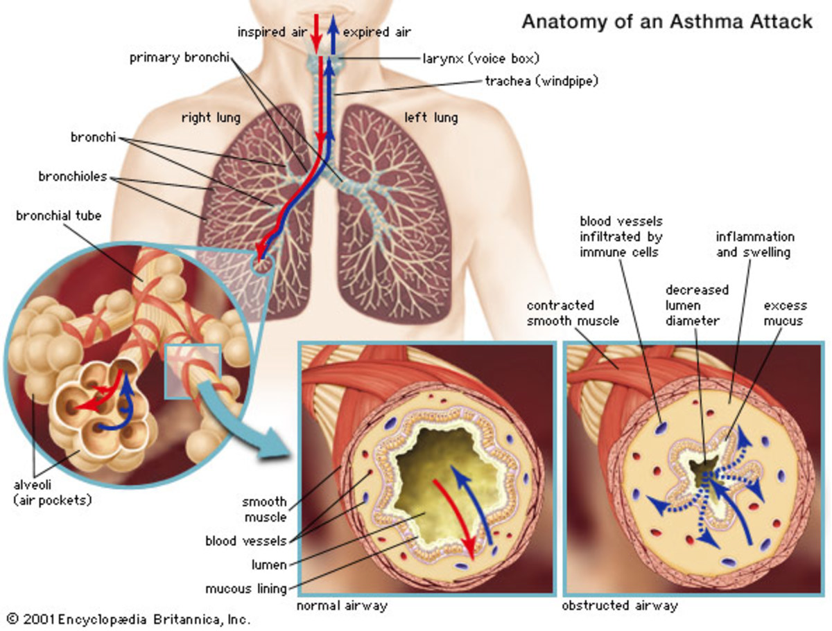 asthma-children