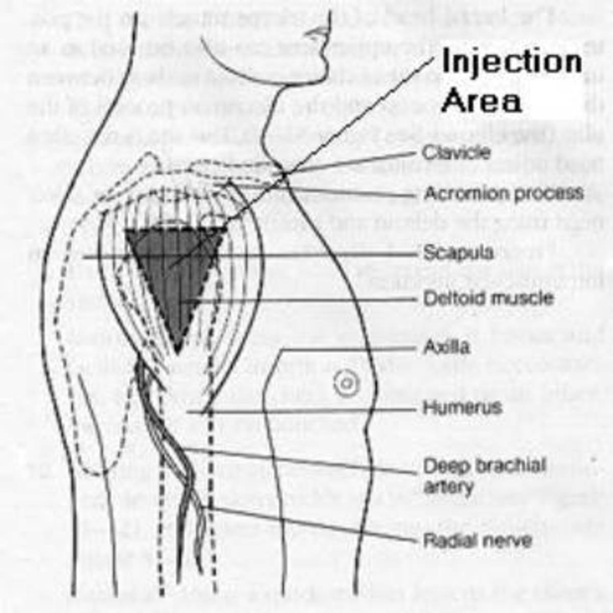 This diagram shows exactly where the anatomical marks are located to help visualize the deltoid intramuscular injection sites location.