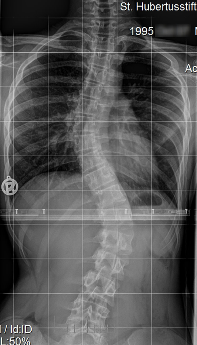 An example of an X-ray of a 15-year-old girl with scoliosis 