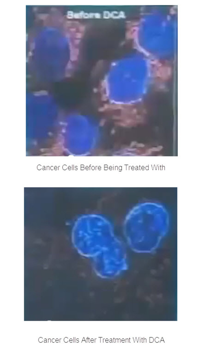 Cancer Cells Before and After Being Treated With DCA